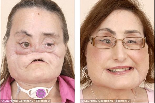 康妮-卡尔普，美国的第一位面部移植患者。左边的照片展示了遭前夫枪击后惨不忍睹的容貌，右边的照片展示了换上新脸后的康妮