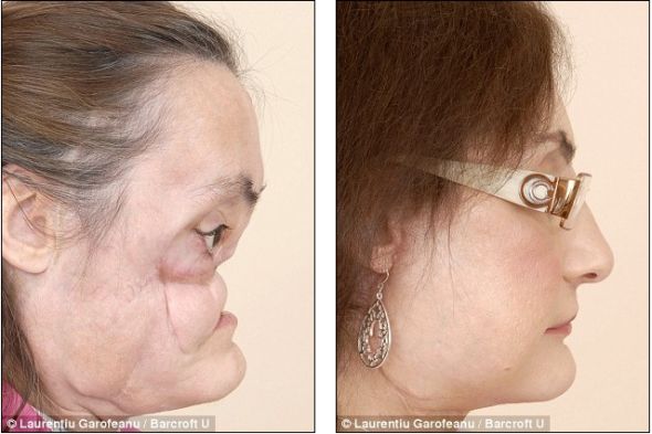 手术前后的康妮面部对比。左边的照片中，康妮的鼻子彻底损毁